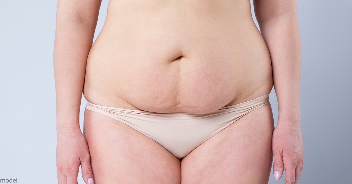 Tummy Tuck Scars-How to Reduce and Conceal the Appearance of a