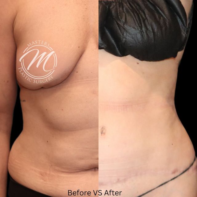 TUMMY TUCK. W/ liposuction 

6months post op

 This patient has recently started the process of scar treatment with our Lutronic lasers.

Did you know @mastersplasticsurgeryokc offers scar treatment packages to your surgery fee at your request? Scar treatment starts 6 weeks after surgery. 

Lasers used for scar treatment
+ CO2
+ TOTALSKIN

SWIPE FOR MORE ⏩️

Call us to Book a consultation 

(405)849-6354

or click the link in our bio.

#tummytuck #liposuction #lipo #lutronics #totalskin #co2 #scartreatment #nicholshills #plasticsurgeon #plastics #boardcertified #newyou #plasticsurgeonsofinstagram #mastersplasticsurgery #drOKC