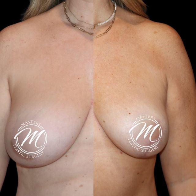 MASTOPEXY COMBINED W/ FAT GRAFTING to the Breast.
 
PUREGRAFT filtration system delivers 97% pure fat for consistent long lasting results! 

3months post op

Call us to Book a consultation

(405)849-6354

or click the link in our bio.

#mastopexy #liposuction #lipo #360lipo  #lift #fatgrafting #Puregraft #nicholshills #plasticsurgeon #plastics #boardcertified #newyou #plasticsurgeonsofinstagram #mastersplasticsurgery #drOKC