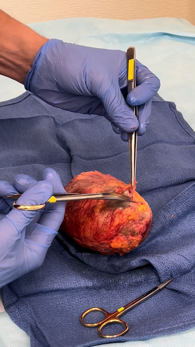 ⚠️WARNING⚠️

The average silicone implant last 10years. Up to 20% of people have their implants removed or replaced within 8 to 10years.

CASE: 80year old woman with ruptured 44 year old implants.