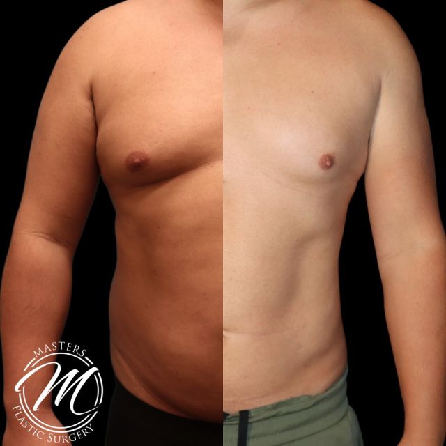 Masters Plastic surgery has the inside scoop for men.

Liposuction is one of the most popular cosmetic surgeries for males. 

Case type: 1year post op Liposuction abdomen & back

SWIPE is amazing results ➡️

Call us to Book 

(405)849-6354

or click the link in our bio.

#liposuction #lipo #awakelipo #malecosmeticsurgery #surgeryformen #nicholshills #plasticsurgeon #plastics #boardcertified #mastersplasticsurgery 
#plasticsurgeonsofinstagram #drOKC