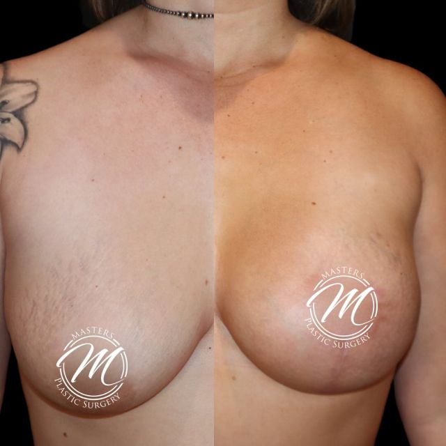 Results at 3 MONTHS

Breast augmentation w/ a lift

Swipe for before 

Call (405)849-6354

or click the link in our bio.

#breastaugmentation #mastopexy #lift
#3monthspostop #nicholshills #plasticsurgeon #plastics #boardcertified #newyou
#plasticsurgeonsofinstagram #mastersplasticsurgery #drOKC